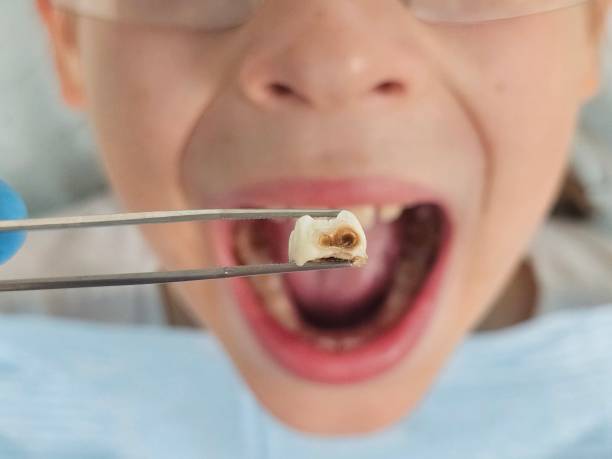 Best Emergency Treatment for Dental Infections or Abscesses in Omro, WI