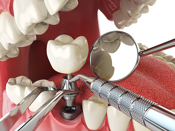 Best Emergency Wisdom Teeth Removal in Omro, WI